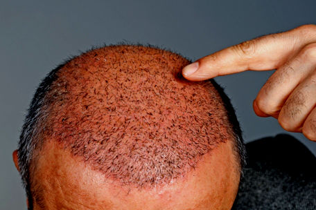 What To Expect After a Hair Transplant Procedure - Sistine Facial Plastic  Surgery