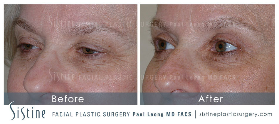 Blepharoplasty Before and After | Sistine Facial Plastic Surgery