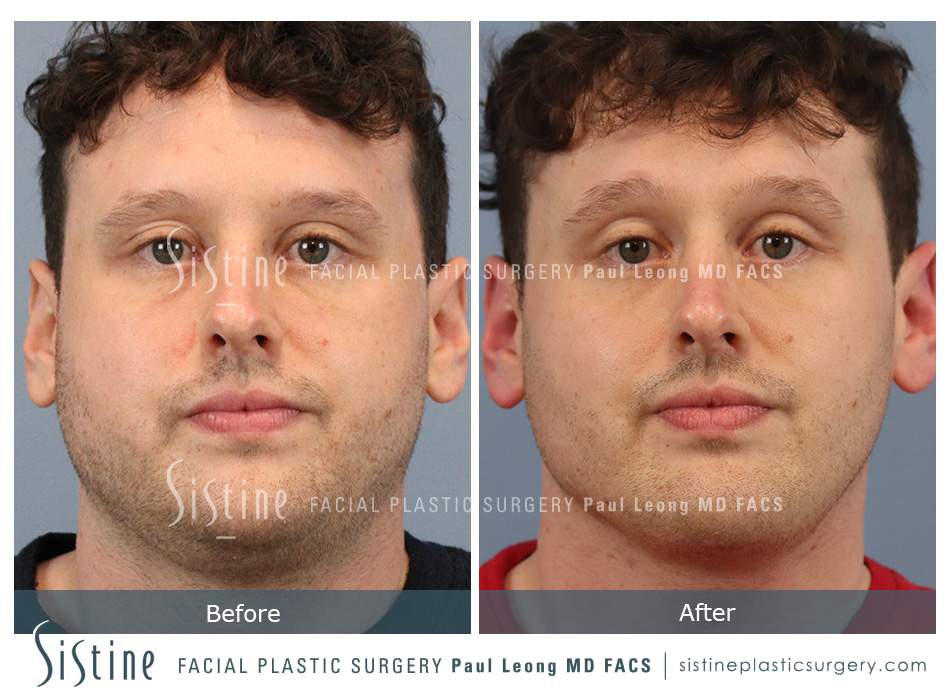 Buccal Fat Removal Before and After | Sistine Facial Plastic Surgery