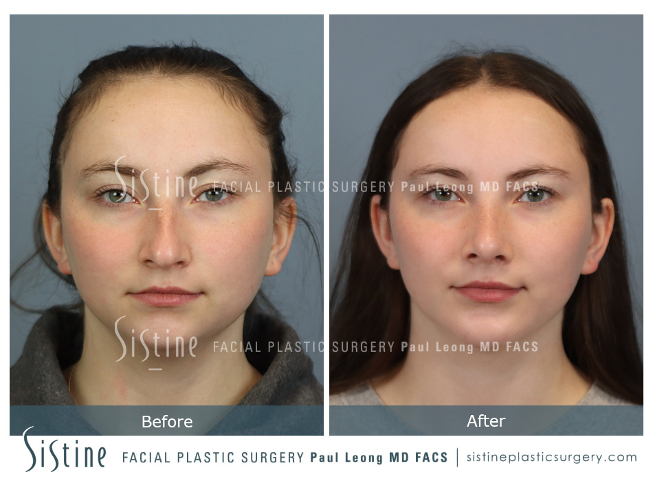 Chin Implant Before and After 05 | Sistine Facial Plastic Surgery