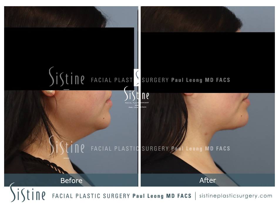 Deep Neck Lift Before and After 04