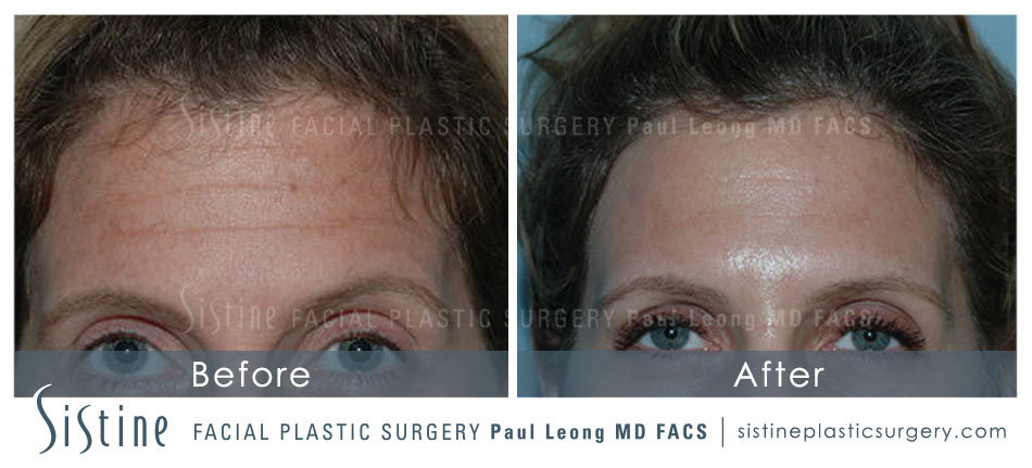 Botox Cosmetic Dysport Before and After | Sistine Facial Plastic Surgery