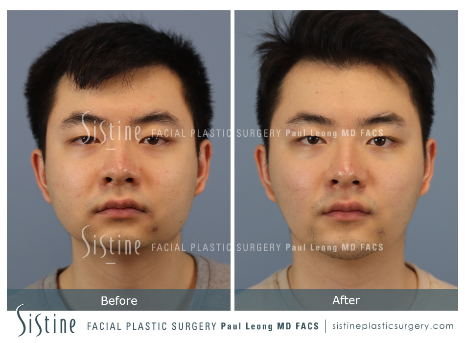 jawline reduction plastic surgery