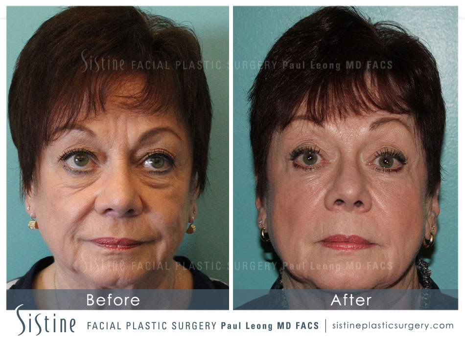 Sculptra Before and After | Sistine Facial Plastic Surgery
