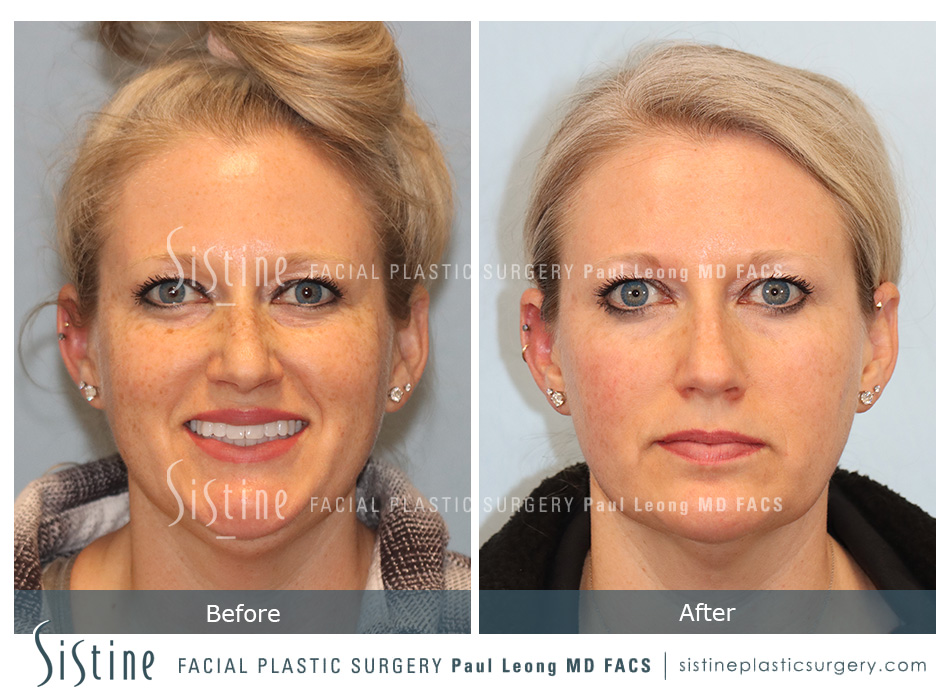 Photofacial Before and After | Sistine Facial Plastic Surgery