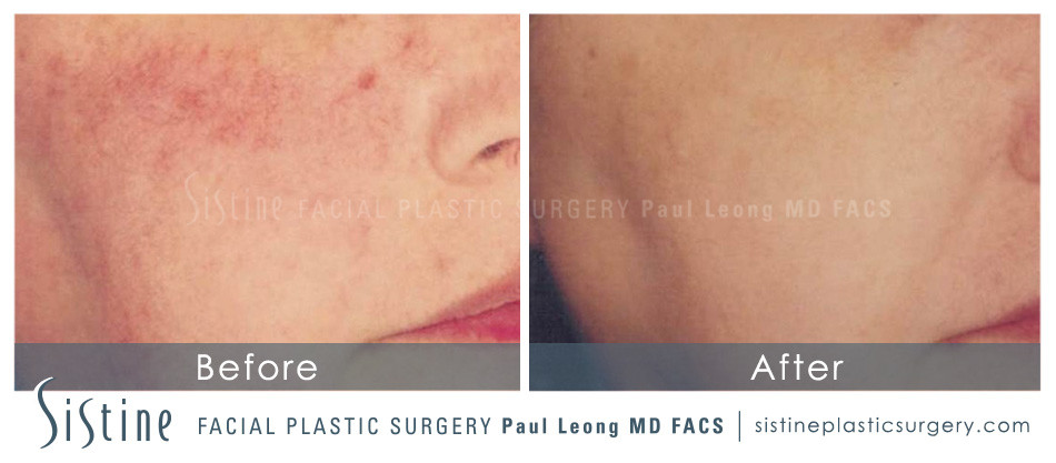 Photofacial Before and After | Sistine Facial Plastic Surgery