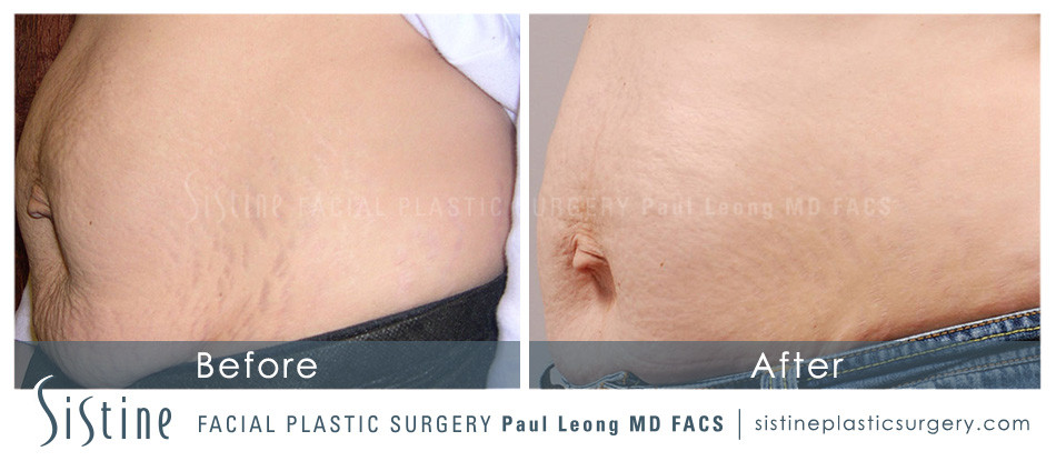 Stretch Marks Before and After | Sistine Facial Plastic Surgery