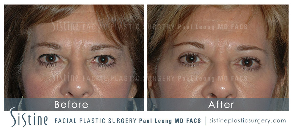 Ultherapy Before and After | Sistine Facial Plastic Surgery