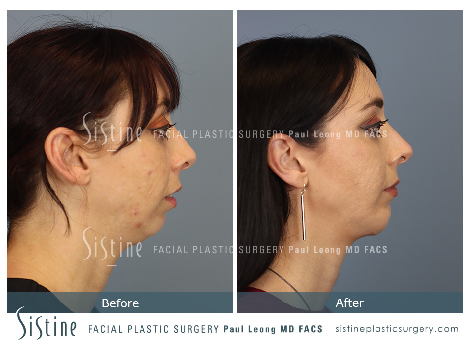 chin augmentation pittsburgh pa before after