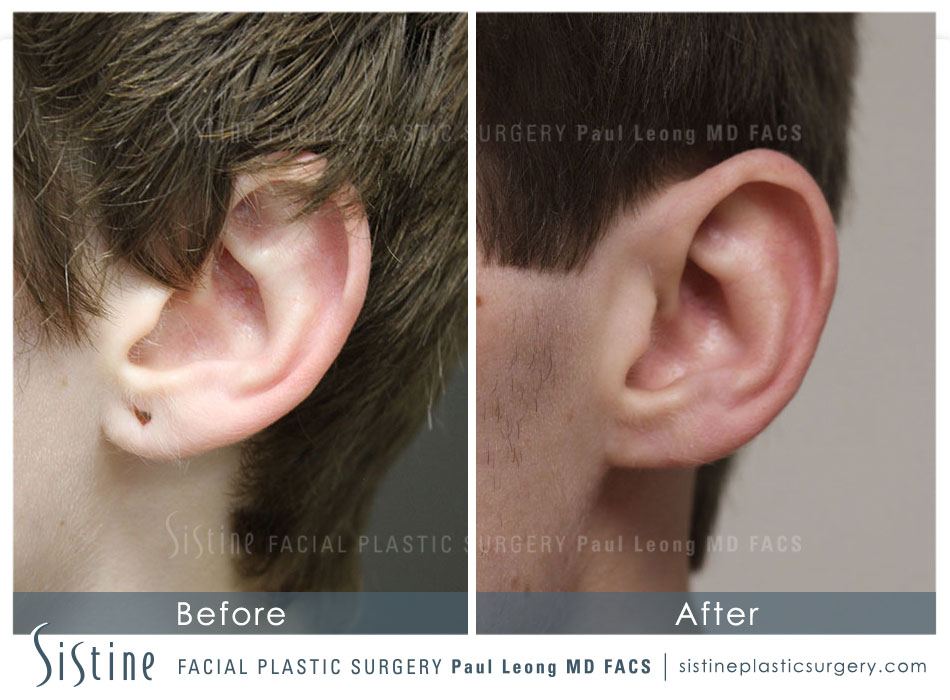 How to Reduce Large Ears and Earlobes - Visage Cosmetic Plastic Surgery