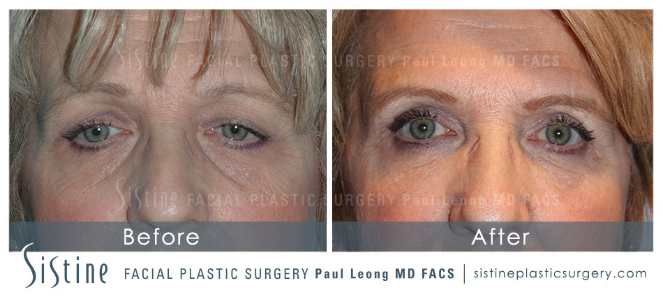 Eyes Before and After | Sistine Facial Plastic Surgery