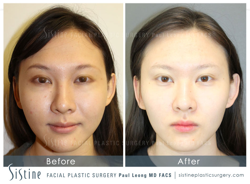 Eyes Before And After 51 Sistine Facial Plastic Surgery