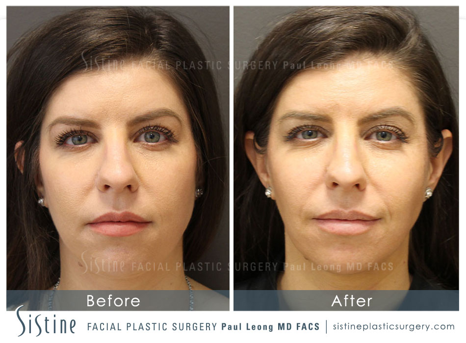 Botox ® masseter - Dr Lucas Plastic Surgery
